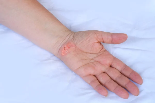 Close Injured Female Limb Damaged Reddened Skin Scratches Wound Painful — Stock Photo, Image