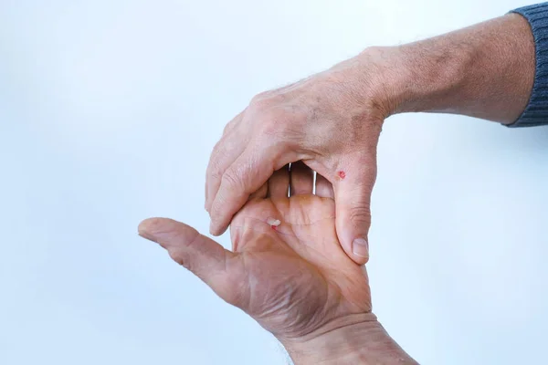 Close Δέρμα Τραύμα Επώδυνο Αρσενικό Χέρι Σκάσιμο Κάλους Στην Παλάμη — Φωτογραφία Αρχείου