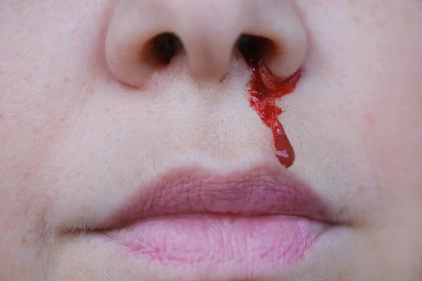 Epistaxis Bright Red Blood Flows Nostril Bright Red Blood Flows — Stock Photo, Image