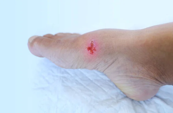 Closeup Του Κλαυθμού Πληγή Τροφικό Έλκος Στο Γυναικείο Πόδι Πληγή — Φωτογραφία Αρχείου