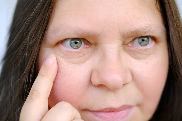 50岁成年女性的特写镜头仔细地观察眼底肿胀 检查面部皱纹 皮肤褶皱 与年龄有关的皮肤变化 美学注射美容术 护理抗衰老程序 — 图库照片