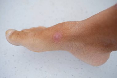 Kadın ayağının yakın plan kısmı, iyileşmiş yaradan kaynaklanan yuvarlak pembe yara, endüstriyel ya da iç yaralanma kavramı, kas ve deri dokularının iyileşmesi, keloid yaraları.