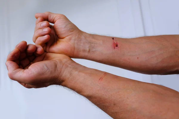 Männliche Hände Mit Wunden Den Unterarmen Abgenutzter Haut Blutungen Geronnenem — Stockfoto