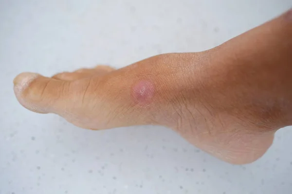 close-up part of female foot, round pink scar from healed wound, concept of industrial or domestic injury, healing of muscle and skin tissues, keloid scars