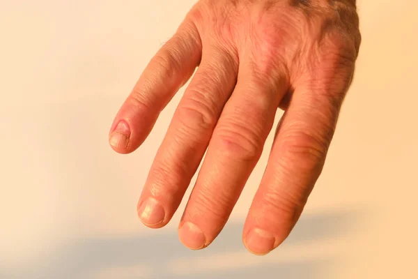 Closeup Trauma Peeling Nail Little Finger Hand Damage Nail Hole — Stock Photo, Image