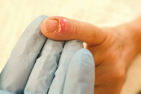 Nagelbeschädigung Und Reparatur Nahaufnahme Nagel Kleinen Finger Der Hand Beschädigung — Stockfoto