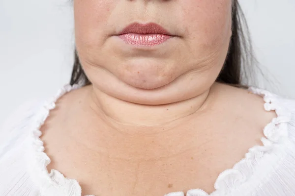Double chin face mature woman 50 years old, human fat neck, wrinkles on skin, facelift, age-related skin changes, aesthetic injection cosmetology, care anti-aging procedures