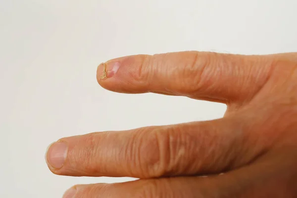 クローズアップトラウマ 手の小さな指の爪の剥離 爪の穴への損傷 絞り込み 引き裂くことによる損傷 — ストック写真