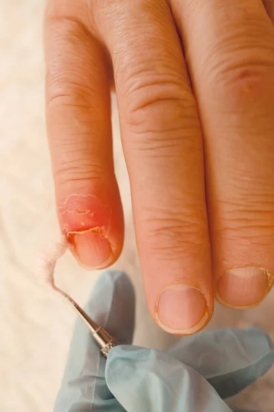 Médico Trata Dedo Lesionado Daños Las Uñas Por Impacto Compresión — Foto de Stock
