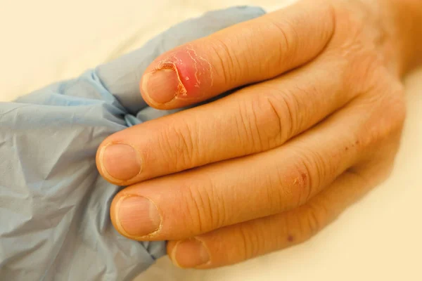 doctor treats injured finger, nail damage from impact, compression, tear, part of male finger injury close-up, bruise, industrial or domestic injury, redness, suppuration