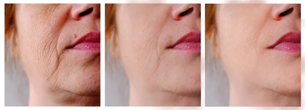 女性の顔のクローズアップ部分40 50歳の年齢のしわ 治療前後の顔のしわ 化粧品の概念 スキンケア 矯正手術 あなたの広告アンチエイジングのためのチラシ — ストック写真