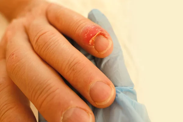 의사는 손가락 손가락 클로즈업 타박상 산업용 가정용 정화의 일부에서 손상을 — 스톡 사진