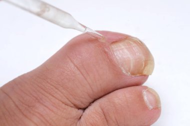 Dermatolog, dermatolog, dermatovenereolog, podolojist kadın ayağının baş parmağındaki hasarlı tırnak bakımı, deri dökülmesi, tırnak mantarı, tırnak onikolizi, paramedikal, tıbbi pedikür, yaşlanma sorunları.