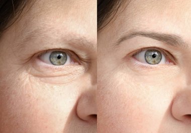 55 yaşında, olgun bir kadın yüzü, insan gözü, alttaki, üst göz kapağı, tedavi öncesi ve sonrası gözlerinin etrafında derin kırışıklıklar, düzeltme ameliyatı, yaşlanma önleyici prosedürler.