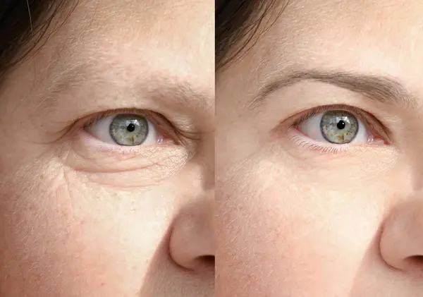 近视部分面部成熟妇女55岁 眼部周围皱纹 治疗前后 矫正手术 抗衰老程序 — 图库照片