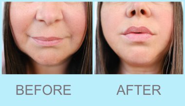 55 yaşında, olgun bir kadın yüzü, insan gözü, alttaki, üst göz kapağı, tedavi öncesi ve sonrası gözlerinin etrafında derin kırışıklıklar, düzeltme ameliyatı, yaşlanma önleyici prosedürler.