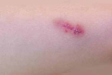 Çocuğun bacağında yara, çocukta iyileşme süreci, cerrahi tıbbi prosedürler dikiş çıkarma, pediatrik tıp