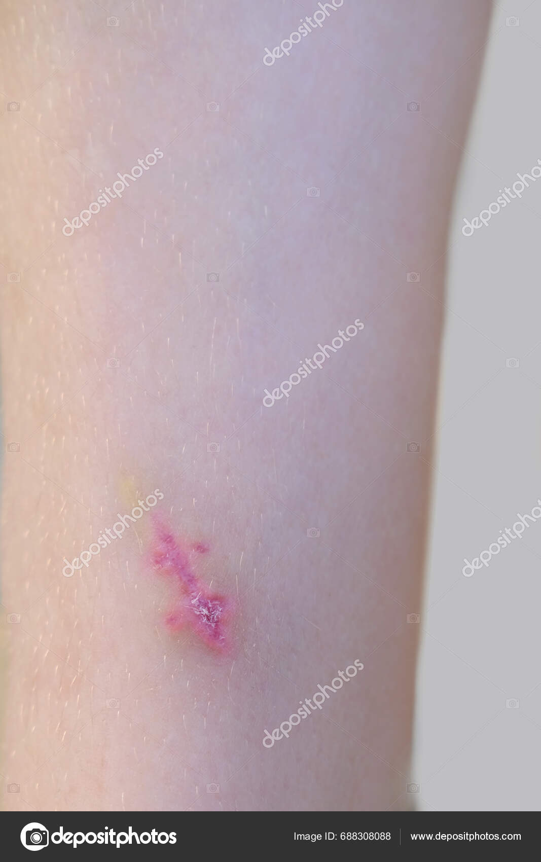 Healing Scar Stitched Wound Child's Leg Wound Healing Process Child