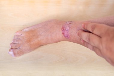 İsilik, kurdeşen, bacağında kaşıntı, iltihap ve tıbbi alerji, hastalıklı kadın hasta, cilt hastalıkları, genel fiziksel ve duygusal sağlık sorunları.