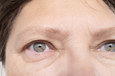 55 yaşında, şişmiş göz kapakları, tıbbî sorunlar ve göz şişkinliğiyle ilgili tedavi seçenekleri, yaşlanmayla ilgili sağlık sorunları olan yaşlı beyaz bir kadının kabarık gözleri.