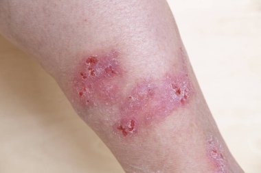 İsilik, kurdeşen, bacaklarda kaşıntı, iltihap ve alerji, kadın hastaların vücutlarında hastalık, cilt bakımı ve cilt sorunları,