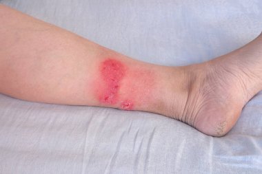 Bacağında yetişkin kadın hastaların yaraları, kızarıklık, ciltte yaralar, tıbbi bakım konsepti, sağlık, insan dokusu yenilenmesi, kadın ayağında haşlanma.