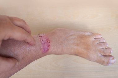 İsilik, kurdeşen, bacağında kaşıntı, iltihap ve alerji, kadın hastaların vücutlarında hastalık, cilt bakımı ve cilt sorunları,