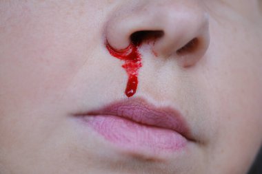 Parlak kırmızı kan burun deliğinden akar, parlak kırmızı kan burun deliğinden akar, yüzün yakın çekim bölümü, kan damarlarının kırılganlığı, kalp hastalıkları, kan basıncında keskin artış