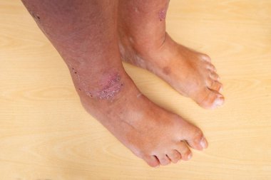 İsilik, kurdeşen, bacaklarda kaşıntı, iltihap ve alerji, kadın hastaların vücutlarında hastalık, cilt bakımı ve cilt sorunları,