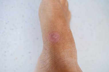 Kadın ayağının yakın plan kısmı, iyileşmiş yaradan kaynaklanan yuvarlak pembe yara, endüstriyel ya da iç yaralanma kavramı, kas ve deri dokularının iyileşmesi, keloid yaraları.