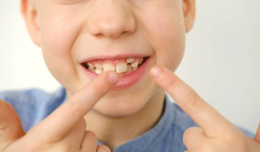 Çocuğun eli, 9 yaşındaki çocuk ağzında yeni bir diş ucu, parmak izi, çocuk sağlığı konsepti, pediatrik dişçilik, tıkanıklığın diş düzeltmesi, çarpık dişlerin tedavisi