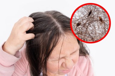 woman scratching head, close-up hair lice, feeling itchy and possibly having lice, showing effects of infestation, Medical conditions, Pediculosis, itching and irritation clipart