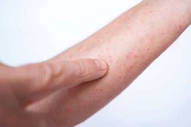 alerjik kızarıklık, iltihaplı deri, dermatit veya alerjik tepki, topikal ilaçlar, kırmızı çıkıntılar, uyuşturucu patlaması