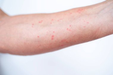 alerjik kızarıklık, iltihaplı deri, dermatit veya alerjik tepki, topikal ilaçlar, kırmızı çıkıntılar, uyuşturucu patlaması