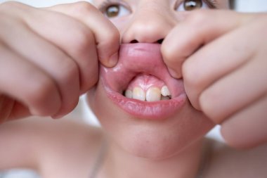 Çocuğun ağız boşluğu, çocuk 10 yaşında. Ağzında yeni bir diş ucu var. Parmak, konsept çocuk sağlığı, pediatrik dişçilik, tıkanıklığın diş düzeltmesi, çarpık dişlerin tedavisi.