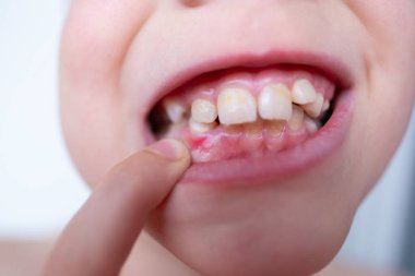 Çocuğun ağız boşluğu, çocuk 10 yaşında. Ağzında yeni bir diş ucu var. Parmak, konsept çocuk sağlığı, pediatrik dişçilik, tıkanıklığın diş düzeltmesi, çarpık dişlerin tedavisi.