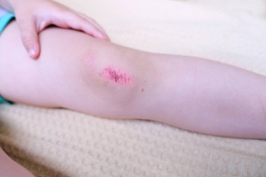 Çocuğun bacağındaki iyileşme yarası, diz bölgesindeki kabuk aşınması, yara izi, çocuklar için travmatik güvenlik konsepti, yaralanmaların tedavisi, sağlık riski, aşınmanın bakteriyel kirlenmesi