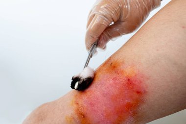 Doktorun elleri, yaralı cilde, kadın uzuvlarına, kronik dermatite, ağrılı kadın bacağına, egzama kızarıklıklarına, deri hasarına, enfeksiyon riskine ilaç sürüyor.