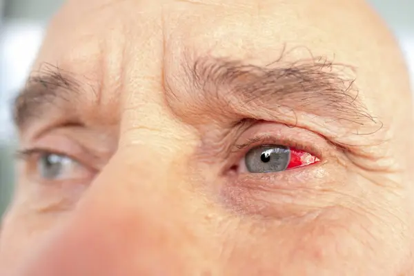 stock image Detailed close-up bloodshot male eye filled with blood due to burst vessel, emphasizing impact strain on vision, Eye health under scrutiny, Detecting vascular issues