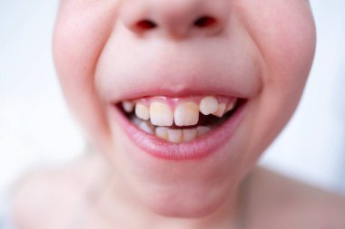 Ağız boşluğu, çocuk. 10 yaşında. Ağzında parmak, konsept çocuk sağlığı, pediatrik dişçilik tıkanıklığın diş düzeltmesi, çarpık dişlerin tedavisi.