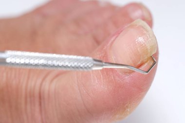 Dermatolog, dermatolog, dermatovenereolog, podolojist kadın ayağının baş parmağındaki hasarlı tırnak bakımı, deri dökülmesi, tırnak mantarı, tırnak onikolizi, paramedikal, tıbbi pedikür, yaşlanma sorunları.