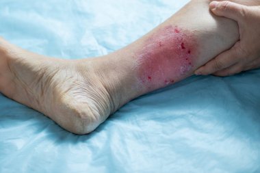 Kronik deri iltihabı, acı veren kadın bacağında yara, tıbbi konsept, kronik durum, dermatolojik bozukluk, deri sorunu, etkilenen bölge.