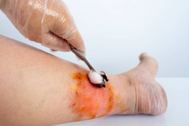 Doktorun elleri, yaralı cilde, kadın uzuvlarına, kronik dermatite, ağrılı kadın bacağına, egzama kızarıklıklarına, deri hasarına, enfeksiyon riskine ilaç sürüyor.