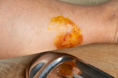 doctor treats large healing wound from on lower leg with scars of adult patient, inflammation and Medical Allergies, scarring skin, scald on female limb clipart