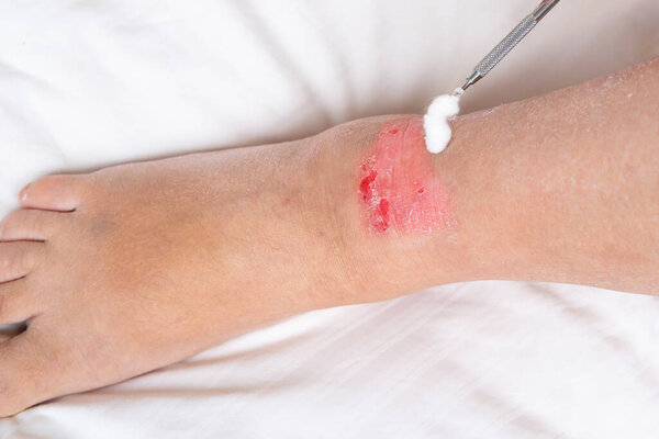 doctor treats healing wound on leg adult female patient, redness, scarring of skin, medical care, human tissue regeneration