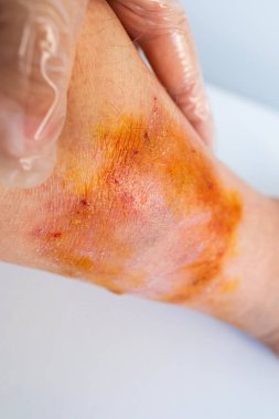 El hemşiresi kadın uzuvlarındaki hasarlı deriyi, ağrılı kadın bacağındaki yarayı, tıbbi konsepti, kronik durumu, dermatolojik rahatsızlığı, cilt sorununu kontrol ediyor.