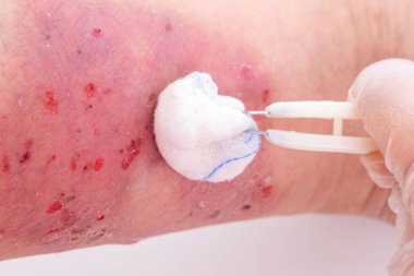 Doktor, bacağının alt kısmındaki büyük iyileşme yaralarını tedavi ediyor. Yaraları, yetişkin kadın hastalar, uzuvları, yara izleri, yara izleri, konsept tıbbi bakım, insan dokusu yenilenmesi.