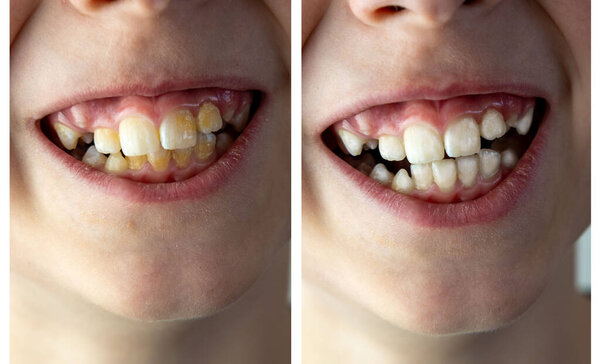 child, kid shows tooth sways and hurts, teeth whitening, pediatric dentistry, dental treatment and correction occlusion, oral care, treatment of crooked teeth, before and after correction