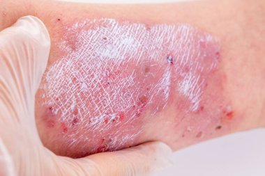 Doktorun elleri, yaralı cilde, kadın uzuvlarına, kronik dermatite, ağrılı kadın bacağına, egzama kızarıklıklarına, deri hasarına, enfeksiyon riskine ilaç sürüyor. 