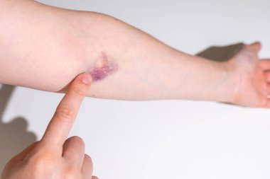 Doktorun elleri, yaralı cilde, kadın uzuvlarına, kronik dermatite, ağrılı kadın bacağına, egzama kızarıklıklarına, deri hasarına, enfeksiyon riskine ilaç sürüyor. 